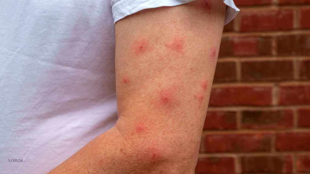 detall d'un braç ple de picades de mosquit