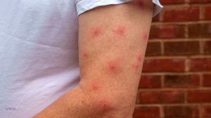 detall d'un braç ple de picades de mosquit