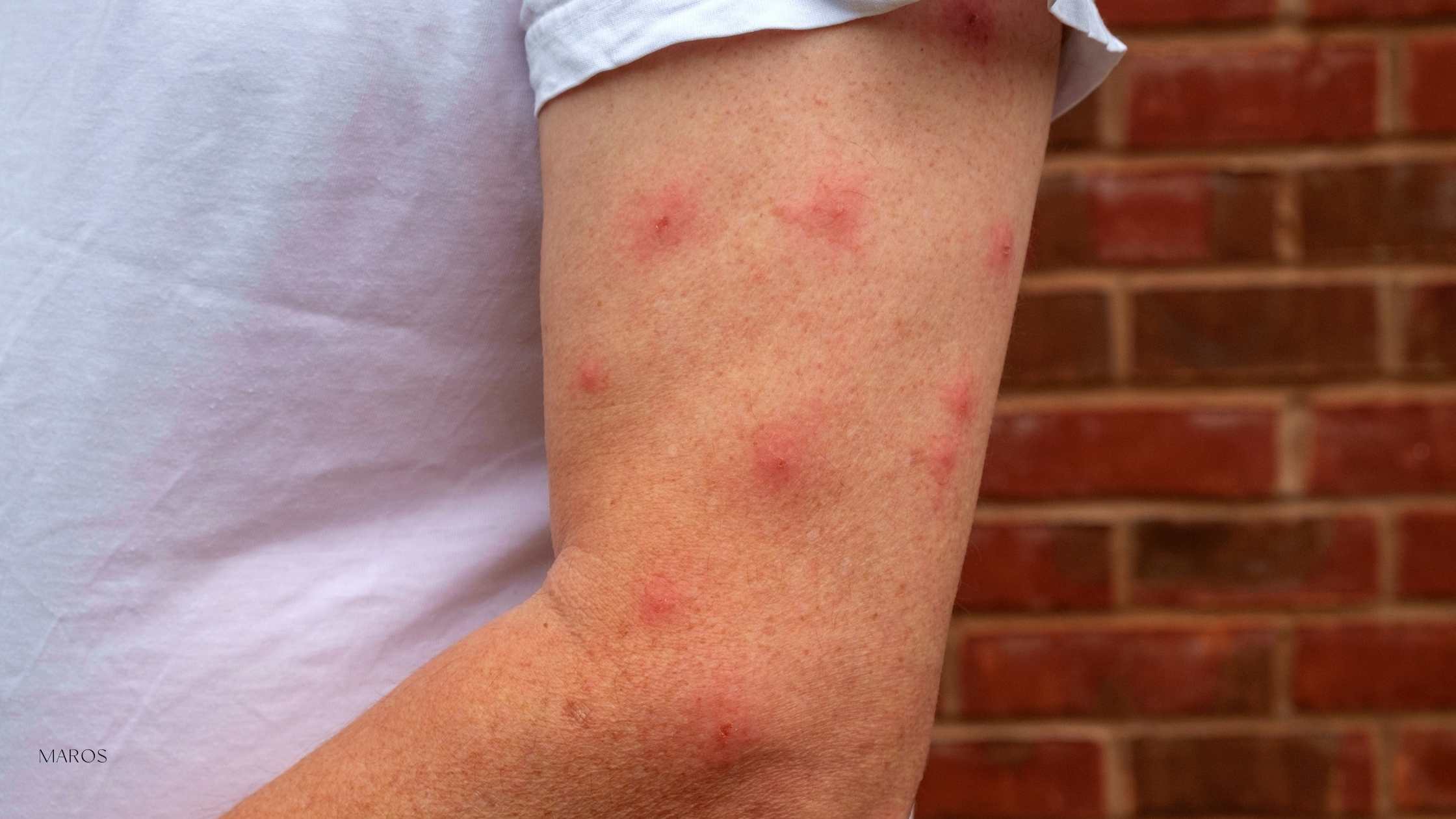 detall d'un braç ple de picades de mosquit