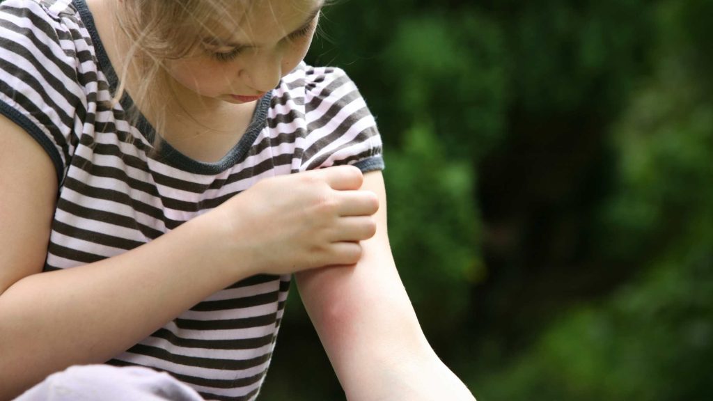detall d'un infant amb una picada de mosquit gratant-se